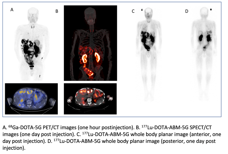 SNMMI Image of the Year: Novel Theranostic Pair Detects, Visualizes Targeted Treatment of Pancreatic Cancer