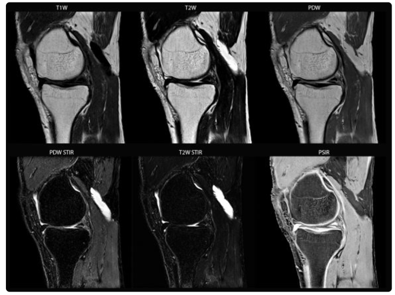 SyMRI MSK Available on Siemens’ Open Apps