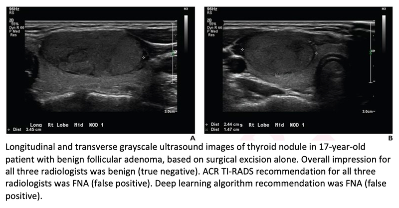 TI-RADS With Deep-Learning-Based Algorithm Guides Evaluation of Pediatric Thyroid Nodules