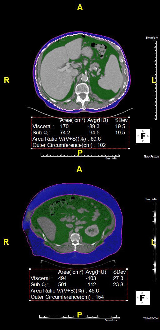 CT helps predict complications after surgery for diverticular disease