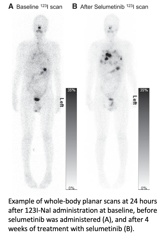 Pretherapy Imaging and Dosimetry Personalizes Treatment Planning for Thyroid Cancer Patients