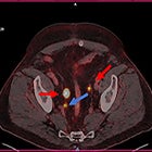 Telix Applauds Updated NCCN Guidelines for PSMA-PET Imaging of Prostate Cancer