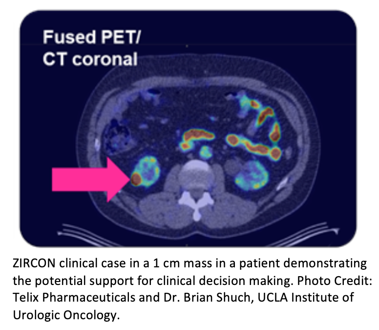 Phase III Study Reports Telix Kidney Cancer Imaging Agent Detects, Characterizes Renal Masses
