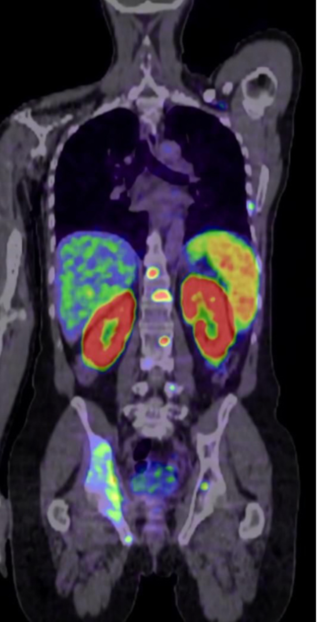 Telix Pharmaceuticals Completes Enrollment in BiPASS Study for Prostate Cancer Imaging