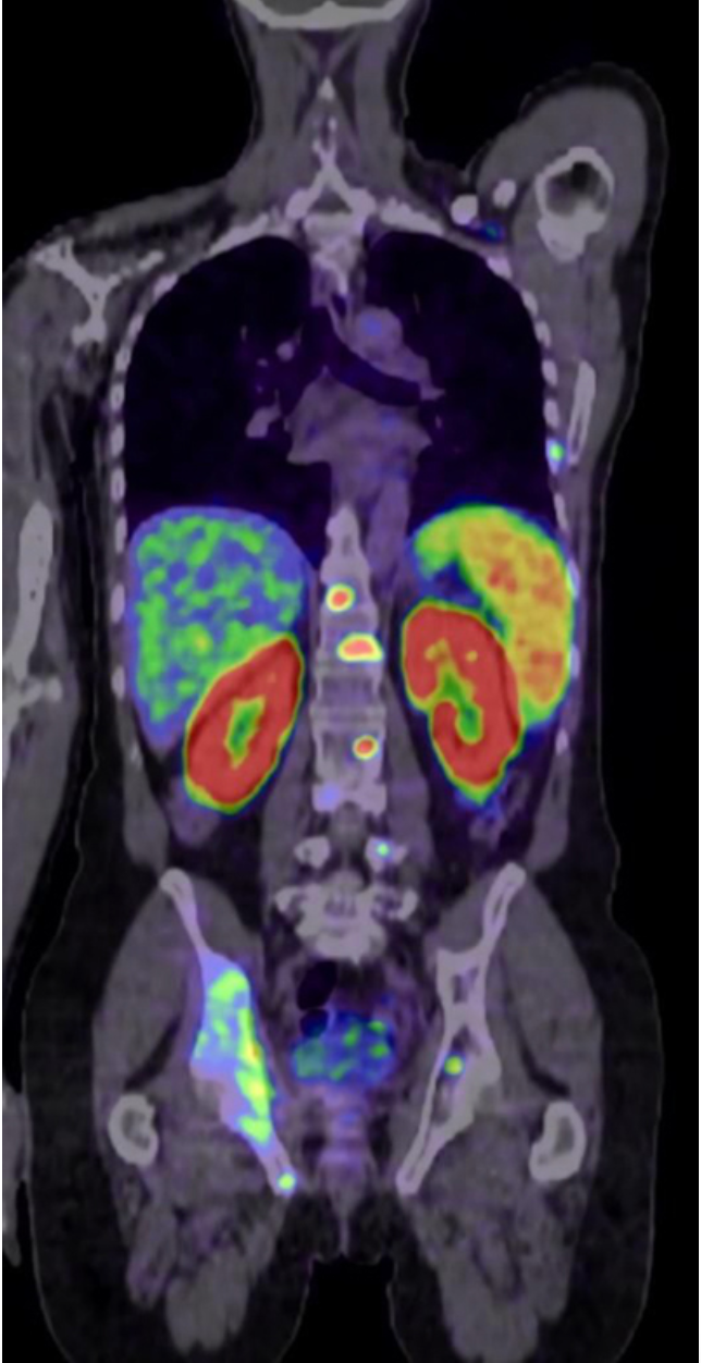 Telix to Start Phase 1 Clinical Trial of Prostate Cancer Imaging Product in Japan
