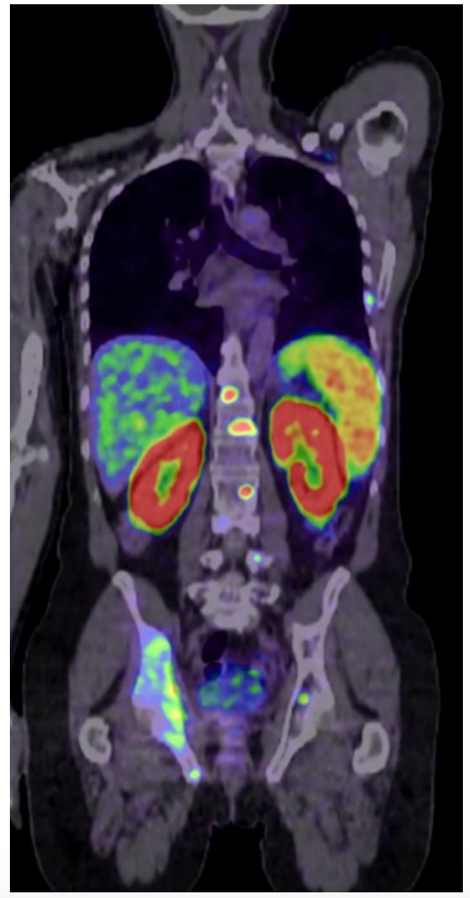 FDA Approves Expanded Indication for Telix’s Illuccix