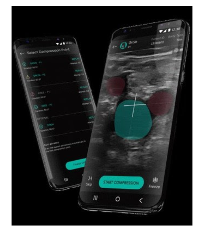AI Algorithm Shows Promise in Diagnosing DVT