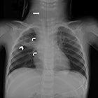 RSNA Announces Cervical Spine AI Challenge Results