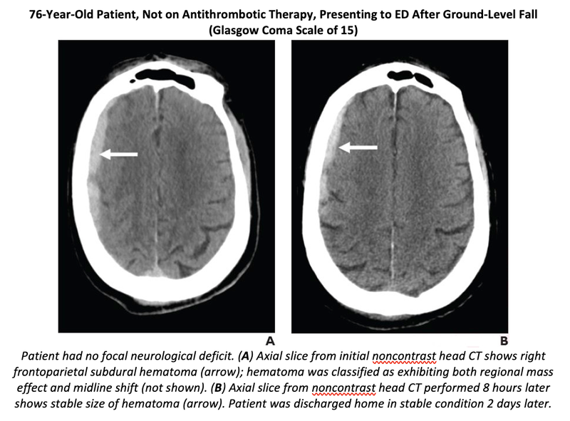 Antithrombotic Therapy Not Linked to Hemorrhage After Fall