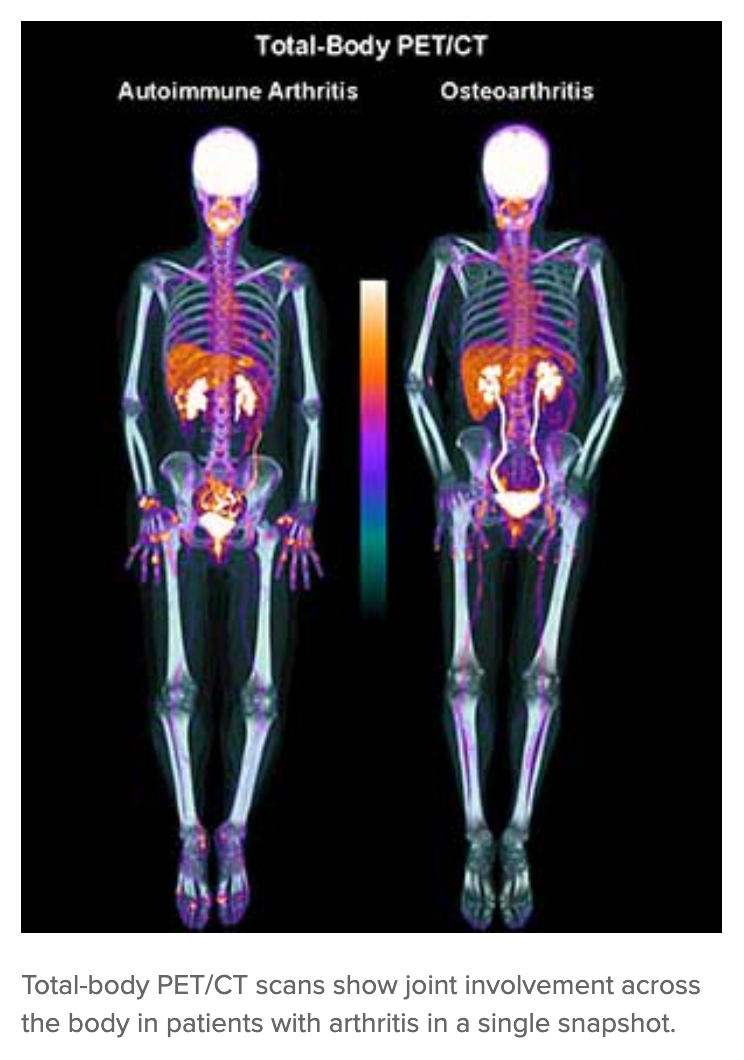 Full-Body PET Identifies Biomarkers of Joint Inflammation