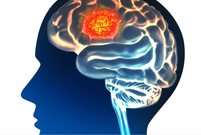 Early Clinical Results for Sonodynamic Therapy of Glioblastoma Show Promise