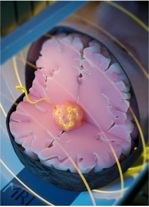 MRI may Help in Fight Against Mesothelioma