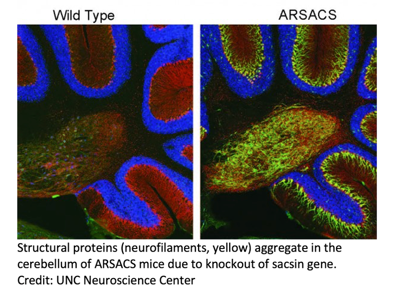 Key Brain Protein in Childhood Movement Disorder Is Revealed