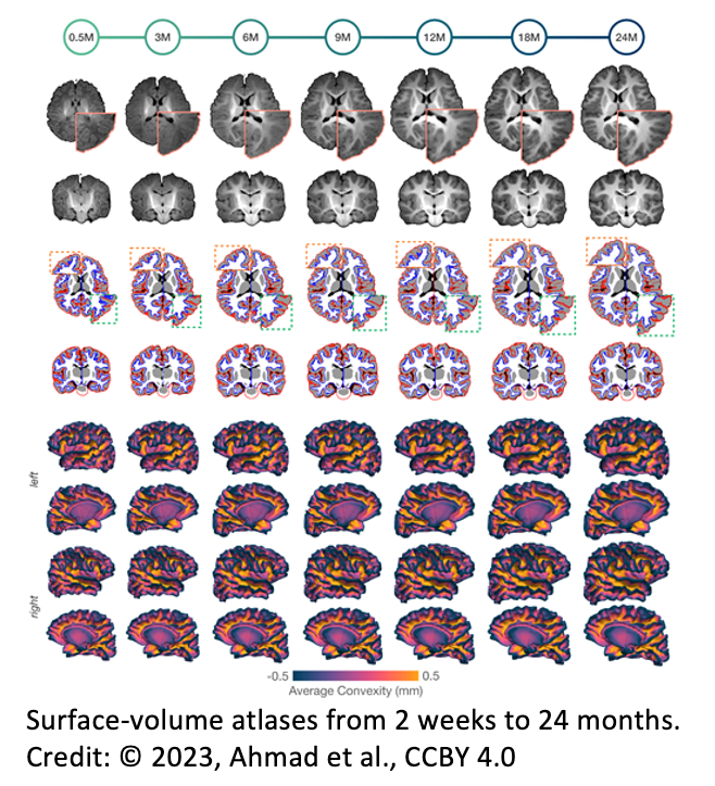 Infant Brain Atlases Unveiled by UNC Researchers