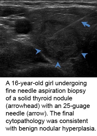 US-guided fine-needle aspiration biopsy of pediatric thyroid nodules appropriate for children