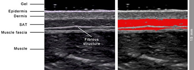 Measuring subcutaneous fat patterning with precision: An ultrasound technique for every body