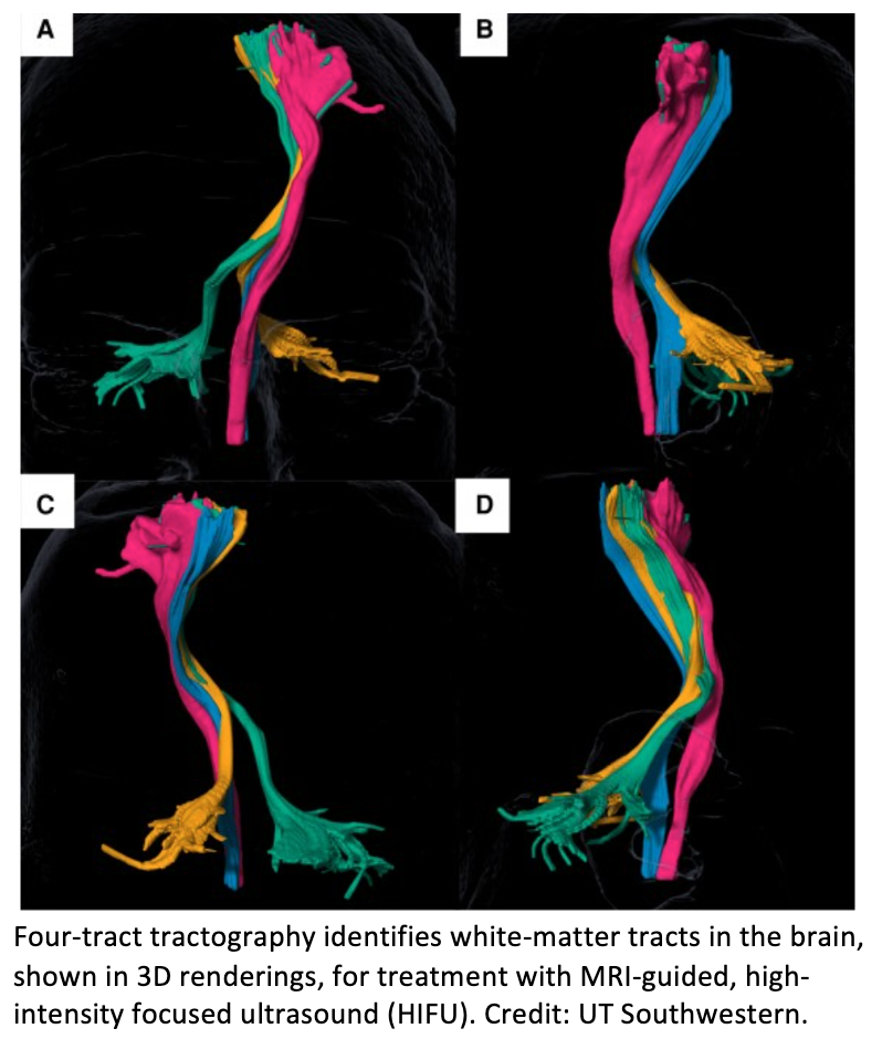 UTSW Develops Technique to Improve Targeting of MR-Guided Focused Ultrasound in the Brain