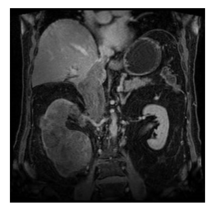 Norroy Bioscience's Kidney Cancer Imaging Agent Achieves FDA Breakthrough Designation