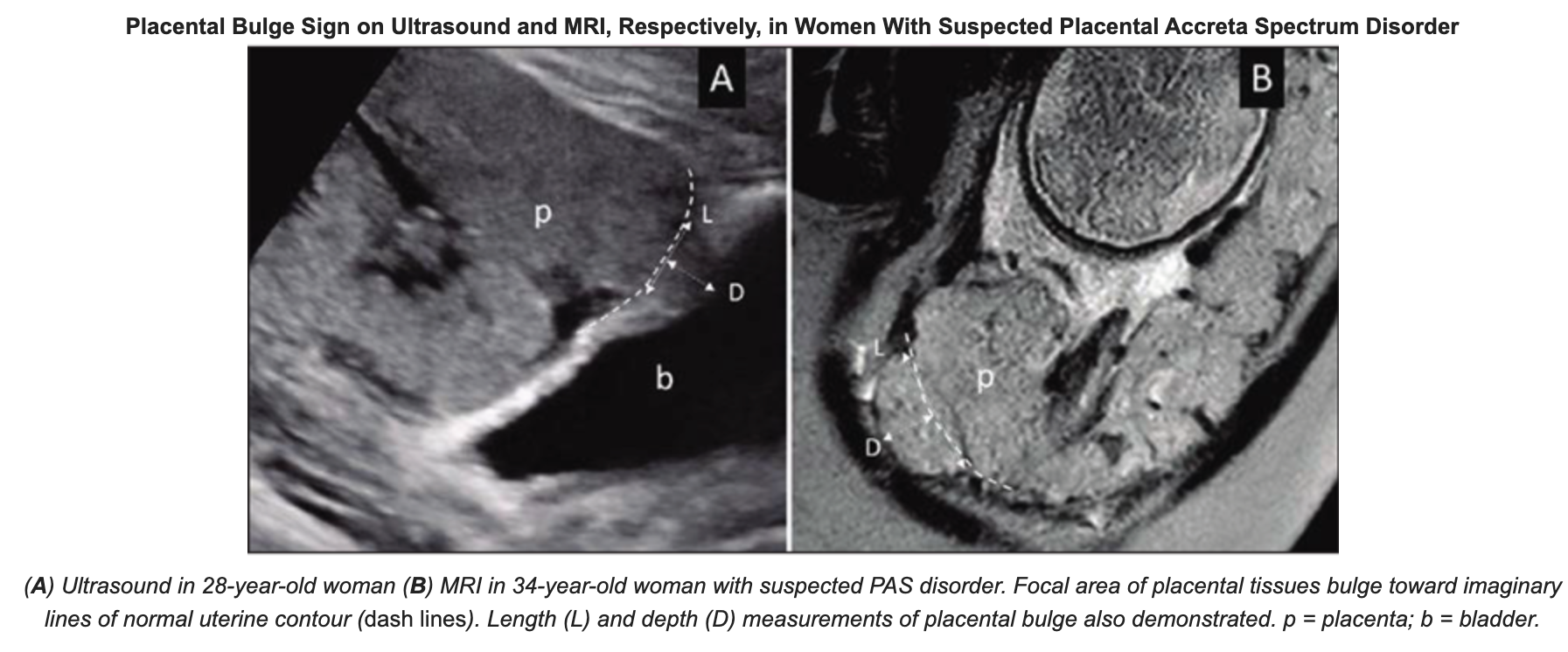 Ultrasound and MR Imaging Aid in Diagnosing Placental Accreta Spectrum