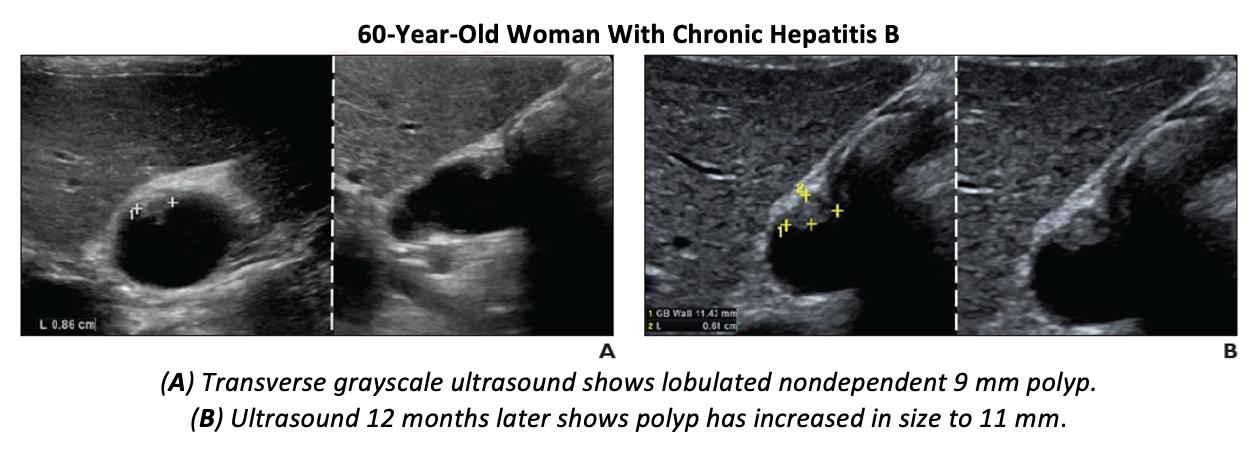 Study Says European Guidelines for Surveillance of all Gallbladder Polyps is too Conservative