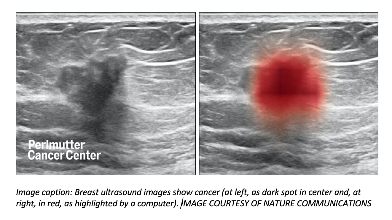 AI Tool Can Improve Accuracy of Breast Ultrasounds