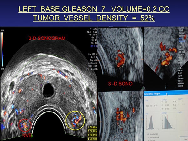 4D-guided prostate treatment: The future of targeted radiation therapy