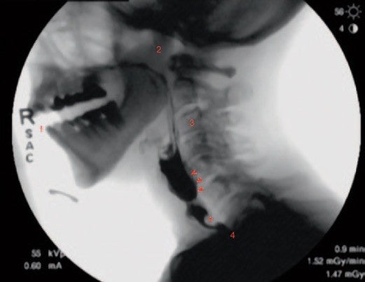 New Guidelines Aim to Standardize Swallowing Fluoroscopy
