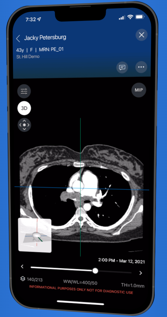 Automated RV/LV Analysis Algorithm for Viz PE Nets FDA Approval