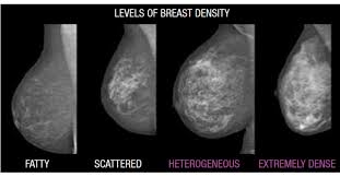 Pairing AI with Breast Density Algorithms Helps Predict Long-Term Cancer Risk