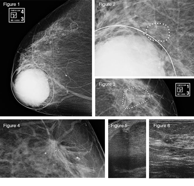 Mammography: Benefit of Computer-Aided Detection