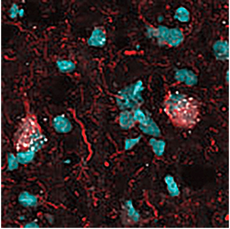 New Protein May Contribute to Alzheimer Disease Progression