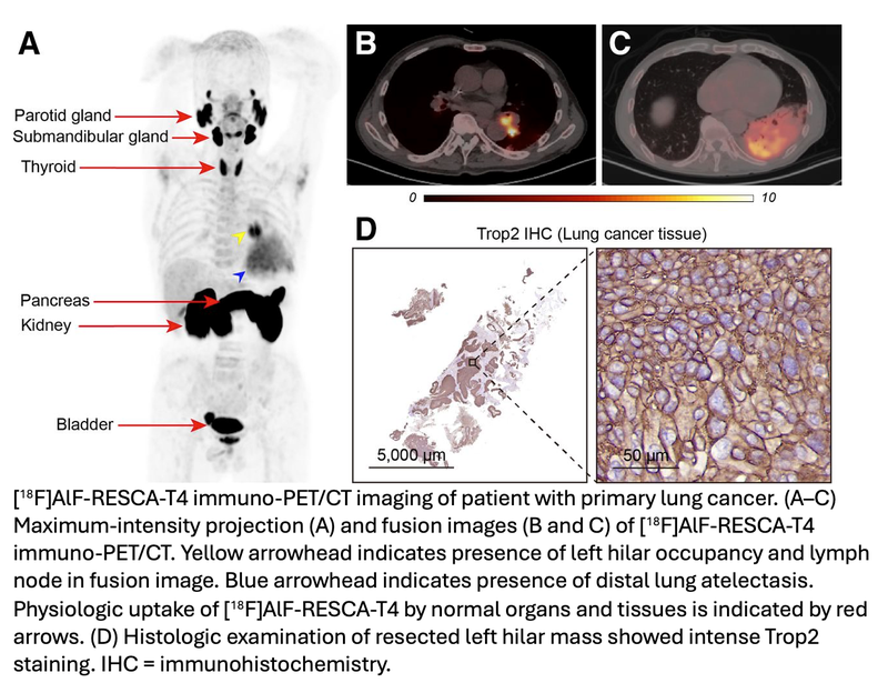 Novel Radiotracer Identifies Critical Cancer Biomarker