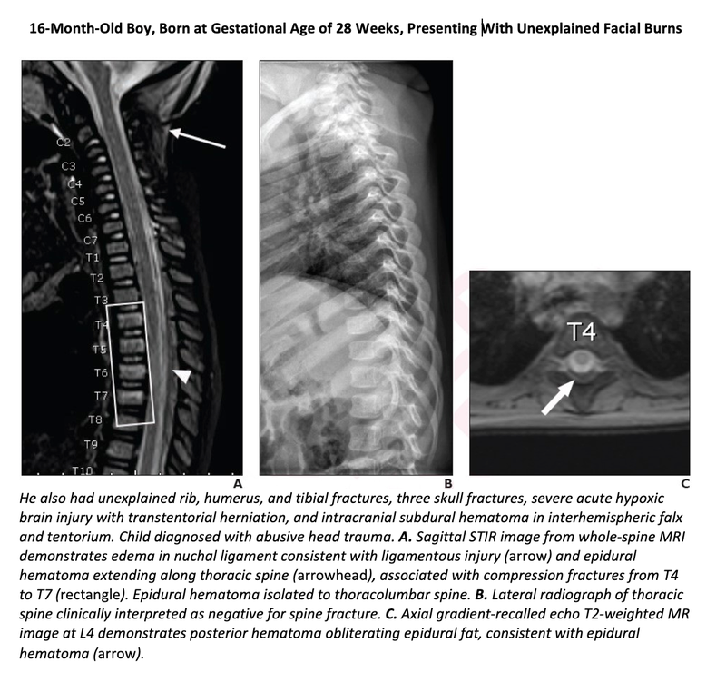 Use Whole-spine MRI in Cases of Suspected Child Abuse