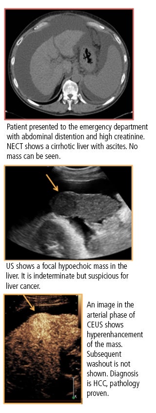 CEUS outperforms non-enhanced CT in abdominal/pelvis imaging