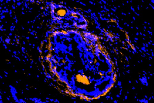 New Imaging Agent Illuminates Cancerous Tumors, Surrounding Cells