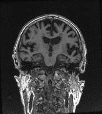 Study Uses Biomarker Data to Better Predict Frontotemporal Lobe Dementia