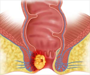 Studies show advances in radiation therapy prolong, improve lives of patients with anal cancer