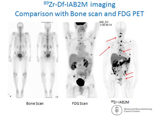 SNMMI 2015: New PET imaging agent is detecting metastasized prostate cancer