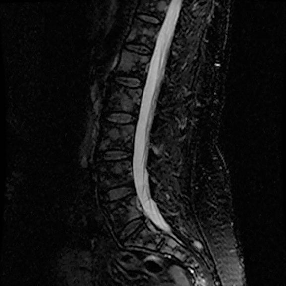 Treating High-Risk, Asymptomatic Bone Metastases May Extend Survival, Reduce Pain