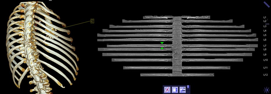 Rib fractures easier to identify with “unfolding” rib CT software
