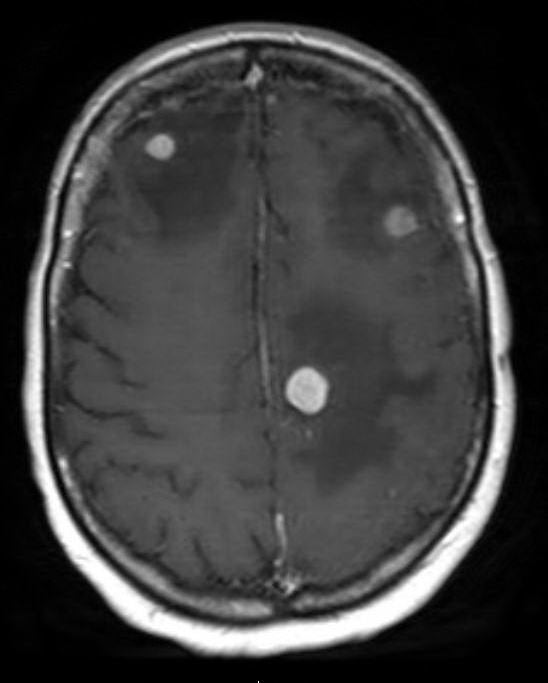 Asymptomatic Brain Metastasis Common in Stage 4 Breast Cancer Patients