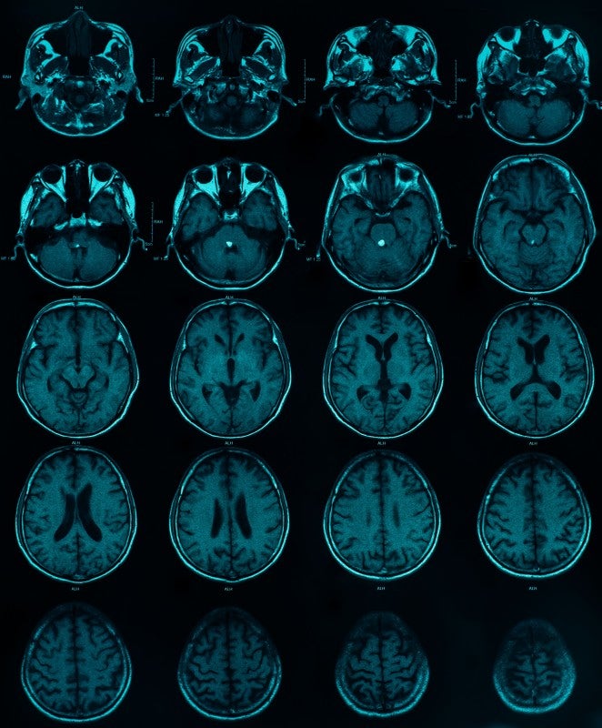 Distinct Immune Cell Types Drive Aggressive Brain Tumors