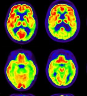 Alzheimer Prevention Trial Receives $74.5 Million NIH Grant