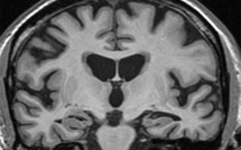 MR Guides Delivery of Magnetic Stimulation Treatment in People With Severe Depression