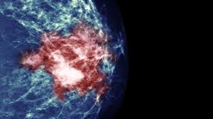 AI Tool Shows Promise in Detecting Hard-to-Find Breast Cancers