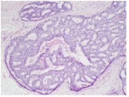 Specific Immune Response May Prevent Spread of Breast Cancer Cells
