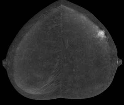 Breast Density Changes Over Time Linked to Cancer Risk