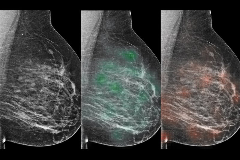 Study Links Breast Calcification Status to Molecular Characteristics