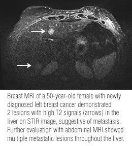 Incidental extramammary findings on breast MRI