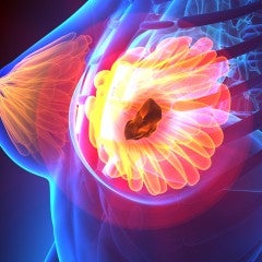 Molecular Breast Imaging Improves Cancer Detection in Women with Dense Breasts